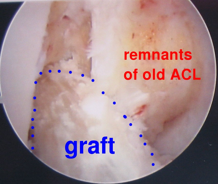 photo of ACL graft