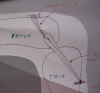 Diagram of how ACL graft is attached to tibia and femur