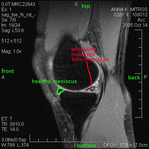 Ania Mitros (Meniscus Surgery: MRI scans)