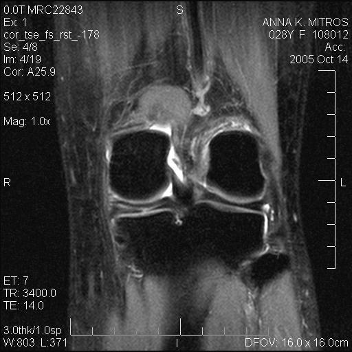 Ania Mitros (Meniscus Surgery: MRI scans)